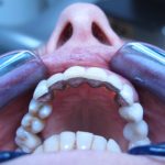 Contention par attelle coulée collée sur terrain parodontal affaibli