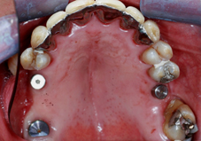 Atelle coulée colée après traitement orthodontique